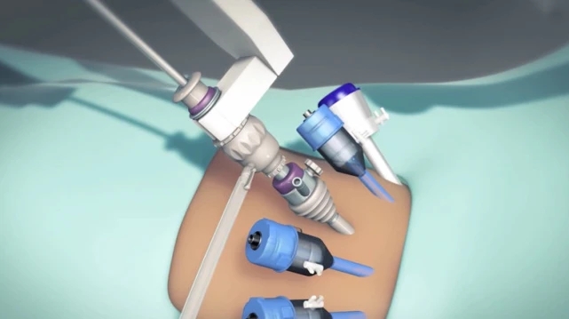 三維醫(yī)學(xué)動畫手術(shù)治療視頻模擬演示制作